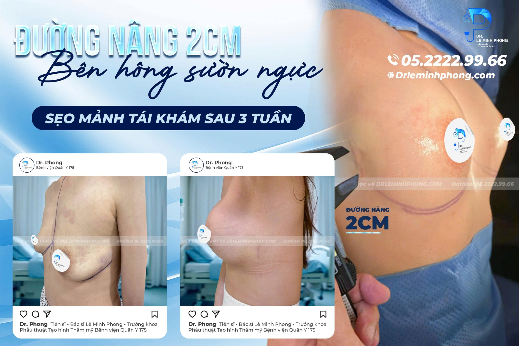 đường nâng 2cm